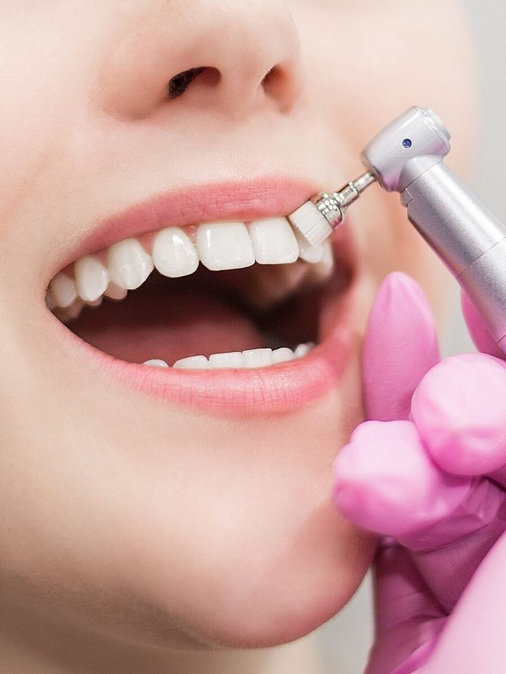 Professional dental scaling and polishing procedure
